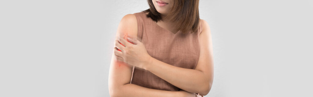 A woman, appearing distressed, clutches her arm where a visible bug bite is inflamed.